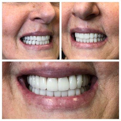 Cosmetic porcelain veneers