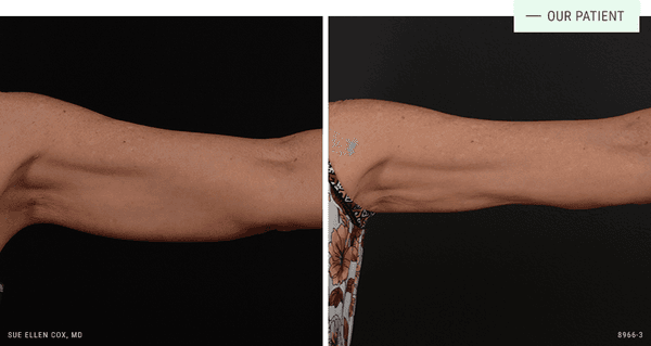 One CoolSculpting treatment to the arms