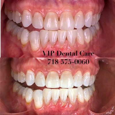 Zoom Whitening at          VIP Dental Care              718 575-0060