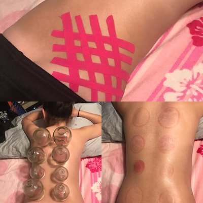 K taping, Cupping and Gua Sha