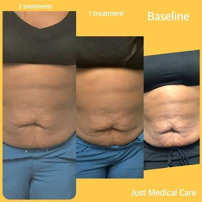 Before and after 2 FlexSure treatments