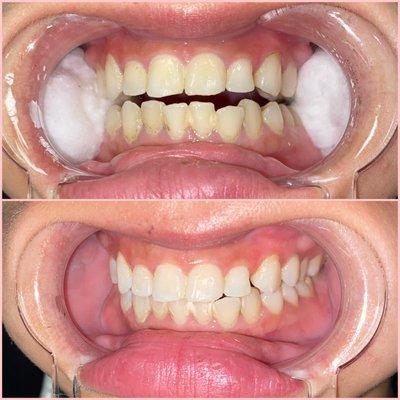 Teeth whitening