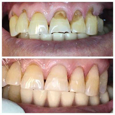 Before and after: Years of over bushing lead to this patients tooth decay.