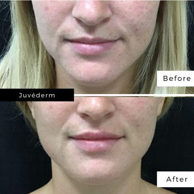 Before and after Juvéderm in lips.