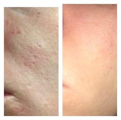 Before and After Scar Treatments (3)