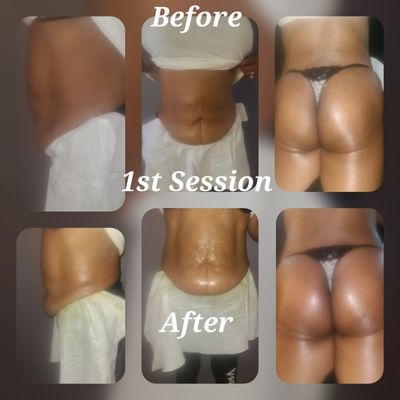 1 Session Of Non-Invasive Lipo Cavitation And Non-Invasive BBL