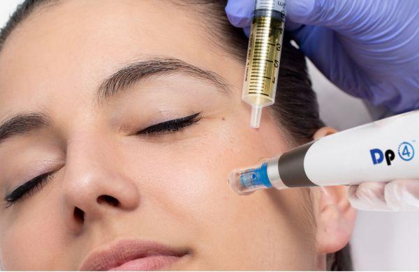 Microneedling by RN under sterile technique FDA approved devices & Clinically proven solutions. Great for acne, scars, wrinkles, dark spots