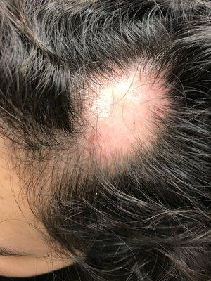 alopecia areata before steroid injection