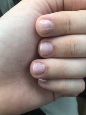 Bleeding and inflamed cuticles