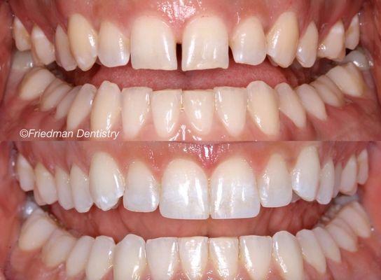 Dr. Matt was able to achieve a natural appearance improving the shape and length of this patients teeth.