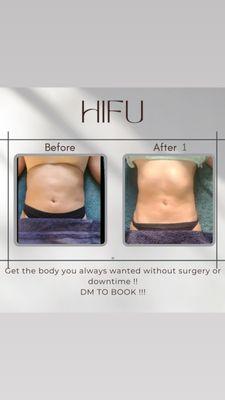 Hifu fat dissolving & skin tightening with high intensity focused ultrasound no downtime !! Fast results !!!