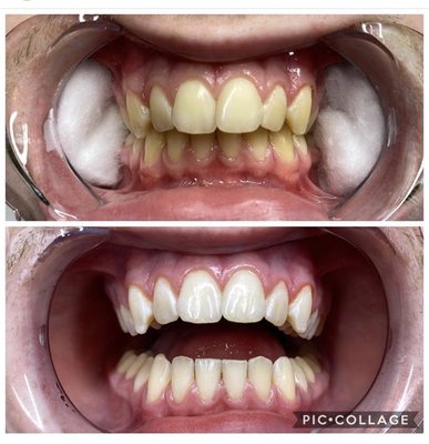 1 hour teeth whitening session