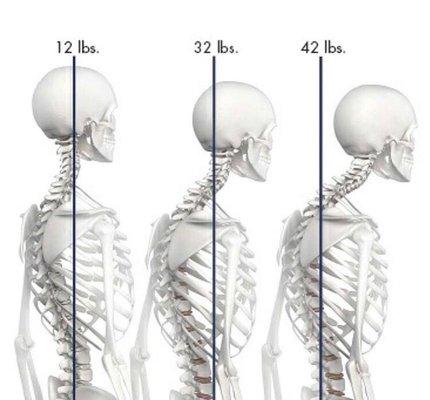 We help with Tech Neck.