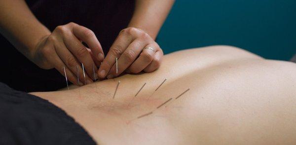 Dry Needling is available!