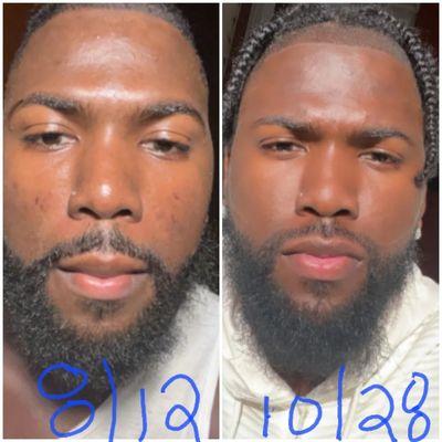 My client Before & After journey to fight his Acne.. YOU GET RESULTS WHEN YOU BOOK WITH BROWN SUGAR SKIN