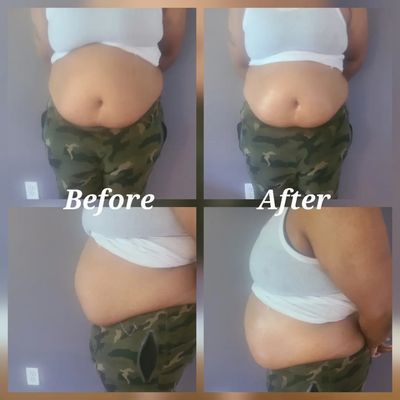 Non-Invasive Lipo Cavitation