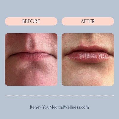 Natural looking lips with skilled filler injection, even thin lips!