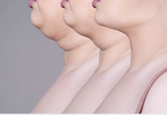 Chin Slimming Procedure - Available in 3 session package