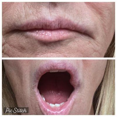 Injected filler to the area outside my lips stating it would decrease the frown.