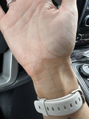 My wrist after following the directions to a tee.