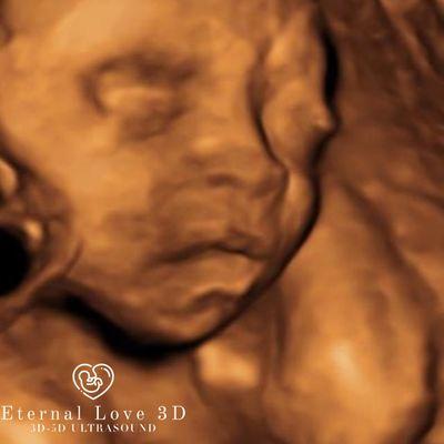 3D Ultrasound