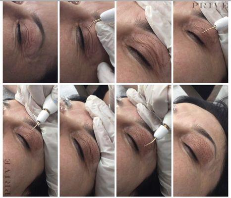 Fibroblast skin tightening, also known as soft surgery, is a revolutionary skin tightening.