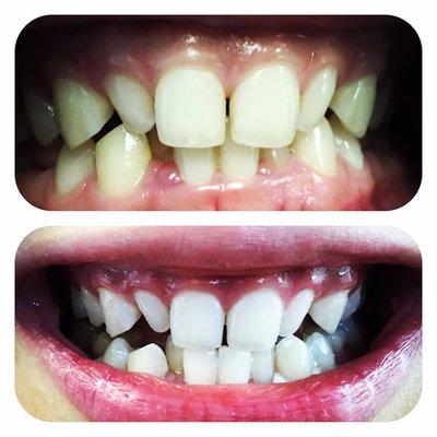 Triple session.  http://vermontteethwhitening.com/