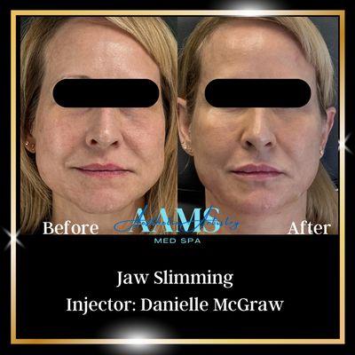 Jaw slimming treatment using neurotoxin