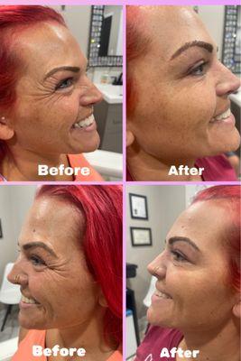 Amazing transformation 2 weeks after Botox cosmetic in the crows feet!