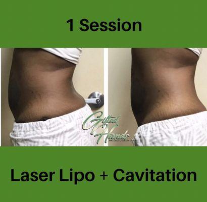 Cavitation + Laser Lipo