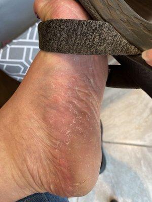 The dead skin isn't even taken off and you can see the darkened callous area on my heel. This was taken at the salon after my "pedicure".