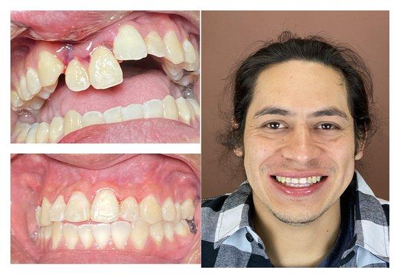 "My two front teeth were knocked out from a soccer game.  They got fixed here by Dr. Le" - Andrew P.