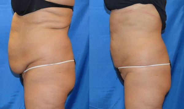 Side profile: Upper and lower abdominal fat removal with full, natural skin retraction.