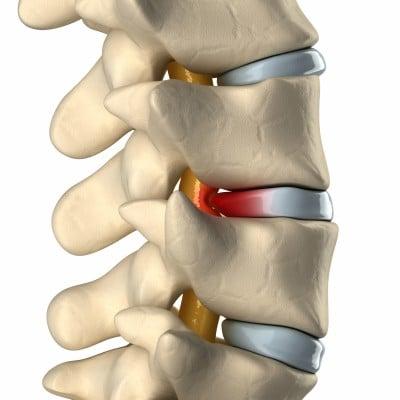 Spinal Rehabilitation