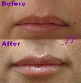 Before and After Juvederm Volbella in the Lips.