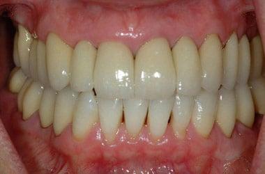 After rehabilitation with ceramic crowns