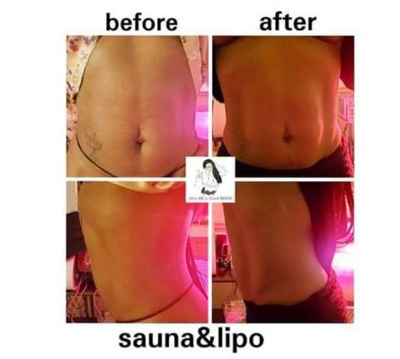 Cavi-Lipo treatment