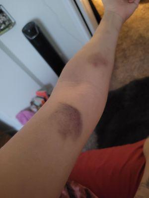 Bruised up from helping move and then having to pay full price.