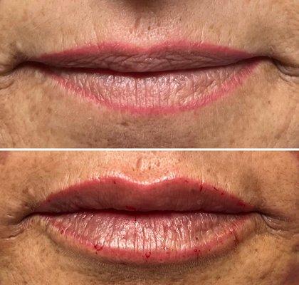 Lip filler