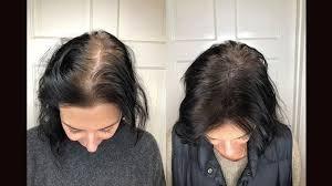 Scalp Micropigmentation