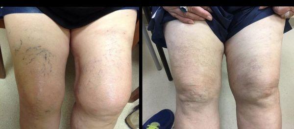 Spider Veins.
Before and After Treatment.