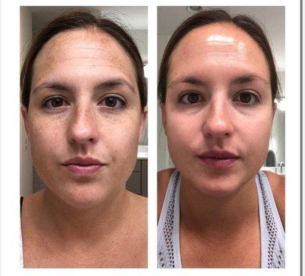 Before and after treatment for melasma, skin discoloration.