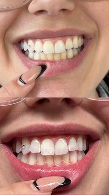 Teeth whitening before and after