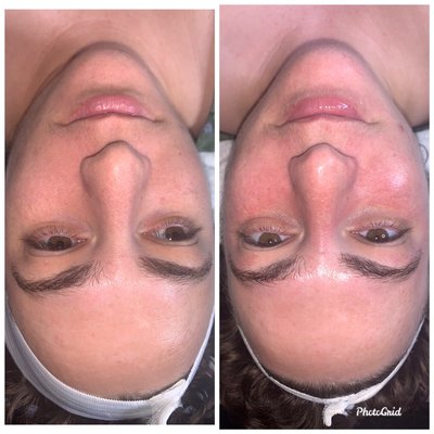 Before and after Vibrant Facial treatment