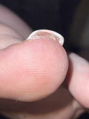 underside of my other big toe