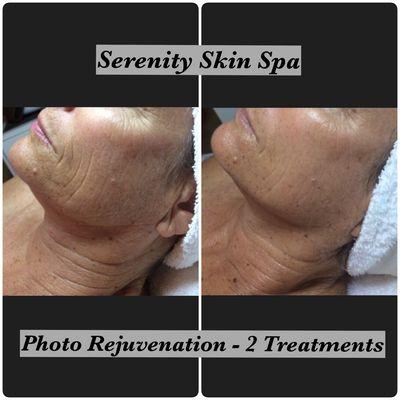 In just two treatments, her results were amazing!  Minimize wrinkles, pores, brown spots, redness and tighten skin with Photo Rejuvenation!