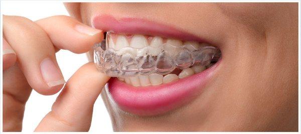 Invisalign Dentist Spring TX 77379, Clear Dental Braces