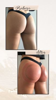 Tighten and tone your glutes with our non-invasive BBL session