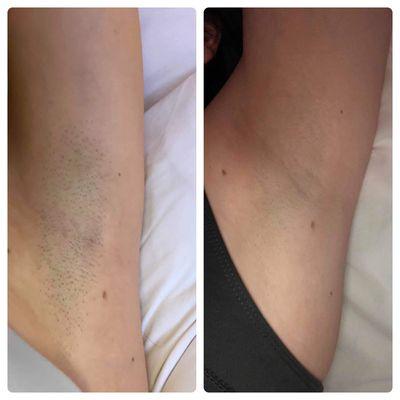 Before & after laser hair removal on underarms!