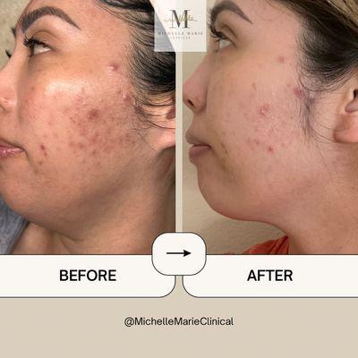 Book the OMG peel now!  28hours after her first treatment!